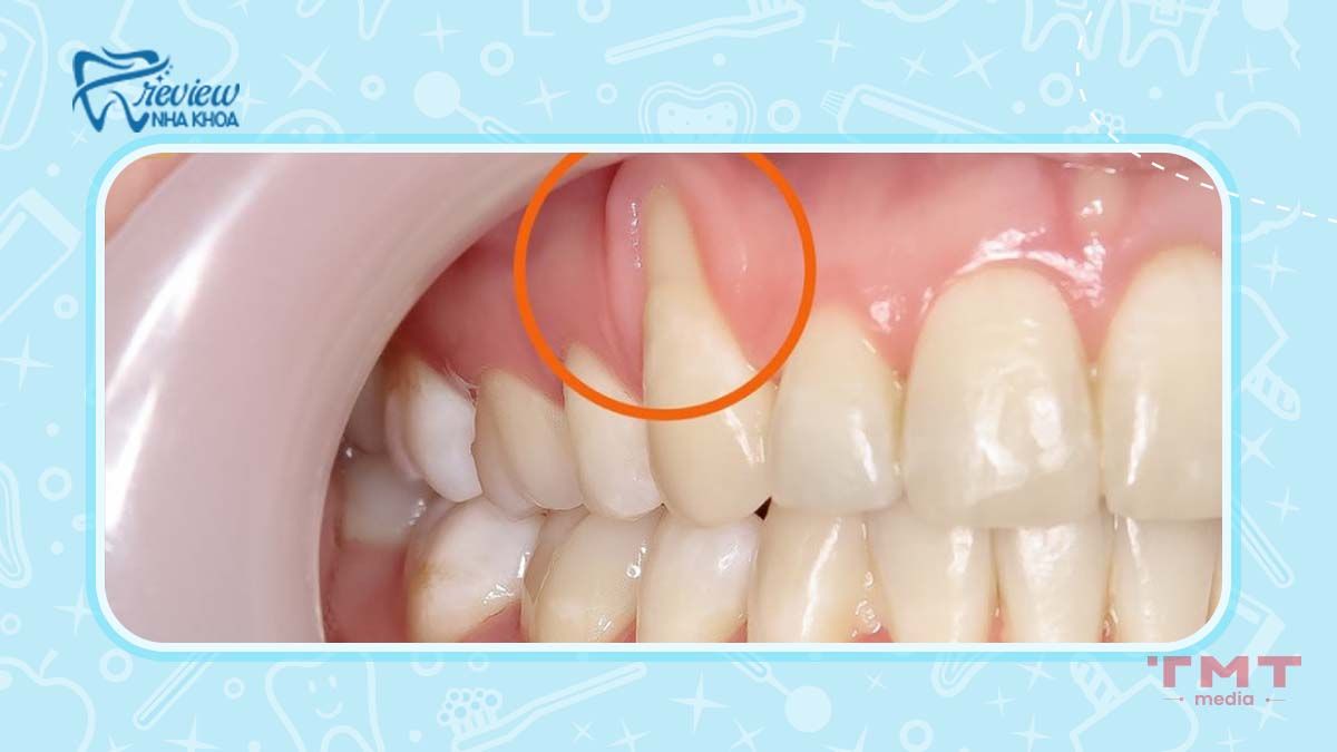 Tụt nướu khiến gây nhạy cảm ở răng