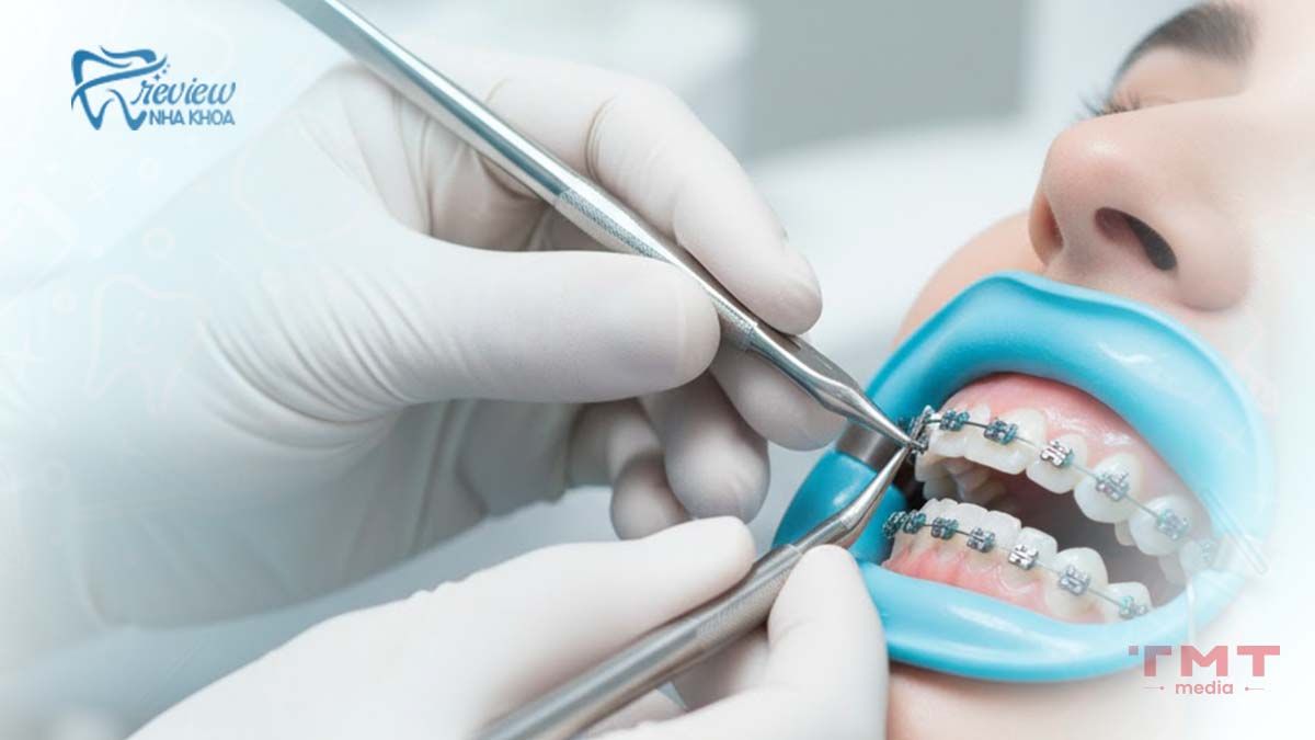 Tháo niềng răng có đau không? Cảm giác thực tế khi tháo niềng răng