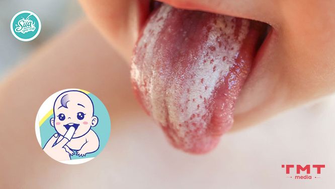 Làm sạch tưa lưỡi cho trẻ sơ sinh